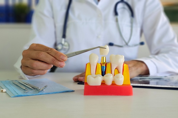 Metal Crowns Vs  Porcelain Dental Crowns